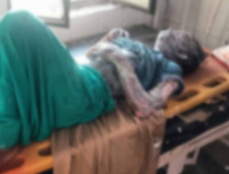 अमरोहा में हुए तेजाब हमले में झुलसी छात्रा ने उपचार के दाैरान तोड़ा दम