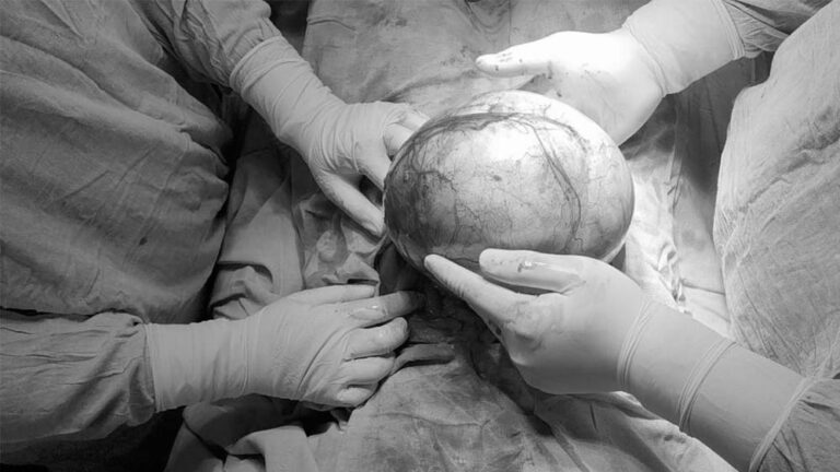 सरकारी अस्पताल में जटिल ऑपरेशन, महिला के पेट से 8 किलो की गठान सफलतापूर्वक हटाई गई