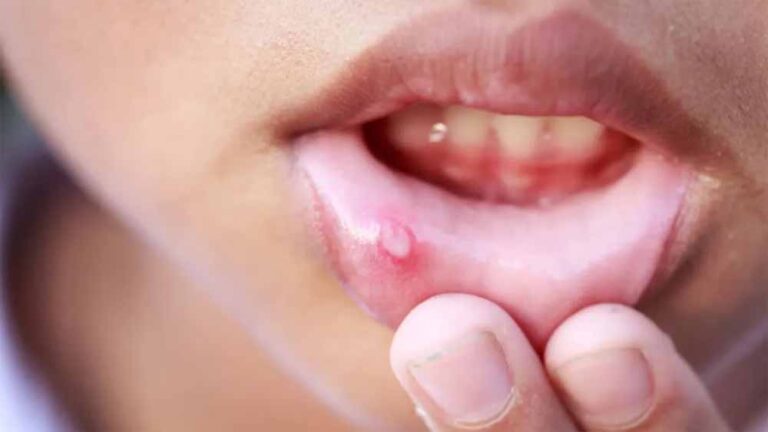 बार-बार होने वाले मुंह के छाले? अपनाएं ये सरल इलाज