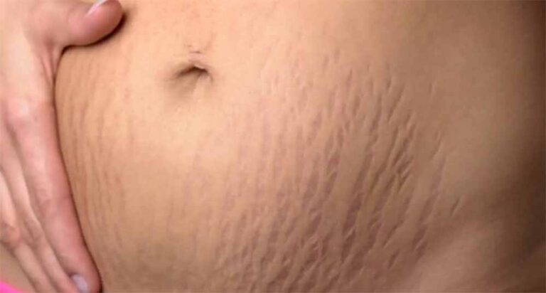 जिद्दी स्ट्रेच मार्क्स से छुटकारा पाने के आसान घरेलू उपाय जिद्दी स्ट्रेच मार्क्स से छुटकारा पाने के आसान घरेलू उपाय