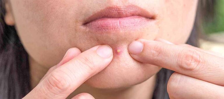 सावधान! पिंपल्स फोड़ने की आदत से हो सकती है स्कारिंग और त्वचा को नुकसान