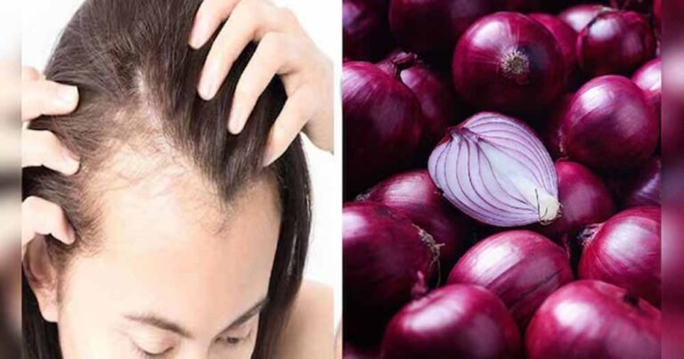 बालों के झड़ने से राहत, घर पर बनाएं प्याज का तेल बालों के झड़ने से राहत, घर पर बनाएं प्याज का तेल
