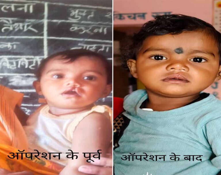 शासन की योजना से दूर हुई बेटी के भविष्य की चिंता, चिरायु दल ने लौटाई मासूम रंजना की मुस्कान