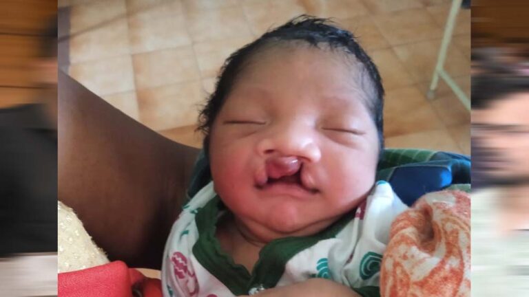 चिरायु टीम ने दिया एक परिवार को नया जीवन, जन्मजात विकृति से जूझ रहे बच्चे को मिली राहत चिरायु टीम की मदद से एक बच्चे को मिला नया जीवन, जन्मजात विकृति से जूझते परिवार की उम्मीद जगी चिरायु टीम ने दिया एक परिवार को नया जीवन, जन्मजात विकृति से जूझ रहे बच्चे को मिली राहत चिरायु टीम की मदद से एक बच्चे को मिला नया जीवन, जन्मजात विकृति से जूझते परिवार की उम्मीद जगी