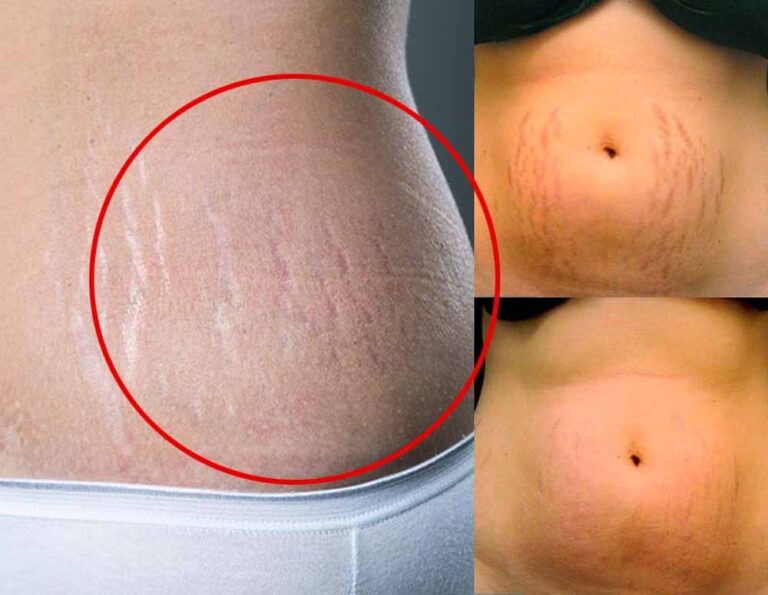 अब स्ट्रेच मार्क्स नहीं! घर पर ही अपनाएं ये घरेलू नुस्खे अब स्ट्रेच मार्क्स नहीं! घर पर ही अपनाएं ये घरेलू नुस्खे