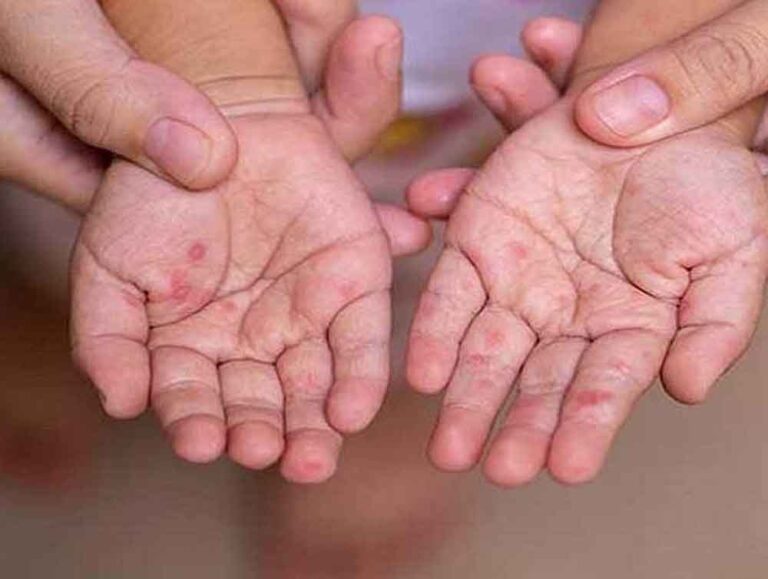 मध्यप्रदेश में बढ़ा खसरे का खतरा: 4 जिलों में 12 केस मिले, स्वास्थ्य विभाग ने जारी किया अलर्ट